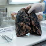 🫁 SESA Querétaro impulsa la prevención en el Día Nacional Contra el Cáncer de Pulmón